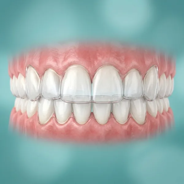 Clear Invisalign Aligners in Gudivada - Krishna Dental Clinic