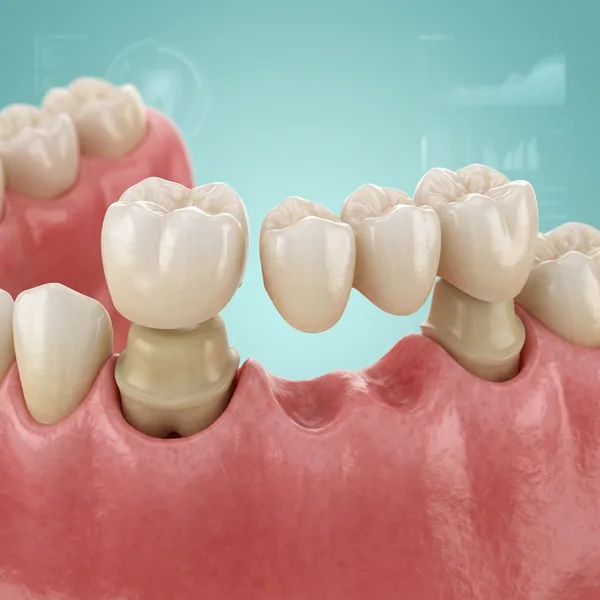 Premium Crowns and Bridges Dental Restoration in Gudivada - Krishna Dental Clinic