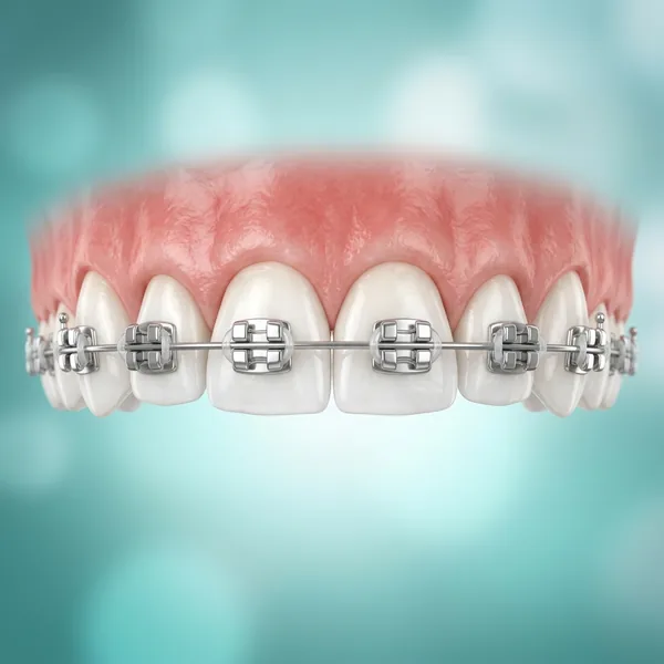 Traditional Dental Braces in Gudivada - Krishna Dental Clinic